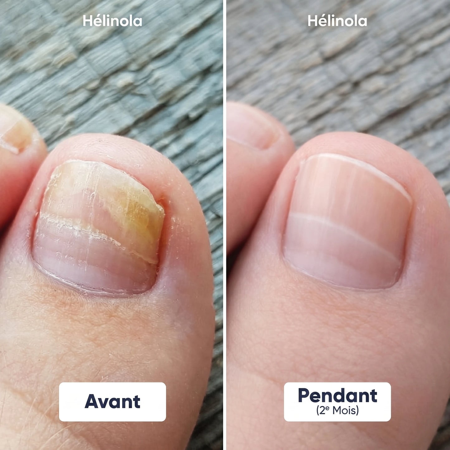 Stylo Traitement des Pieds