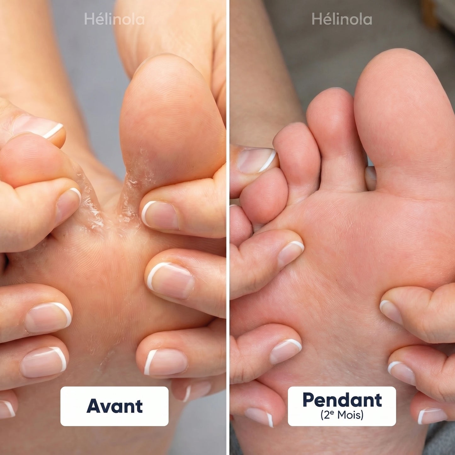 Stylo Traitement des Pieds