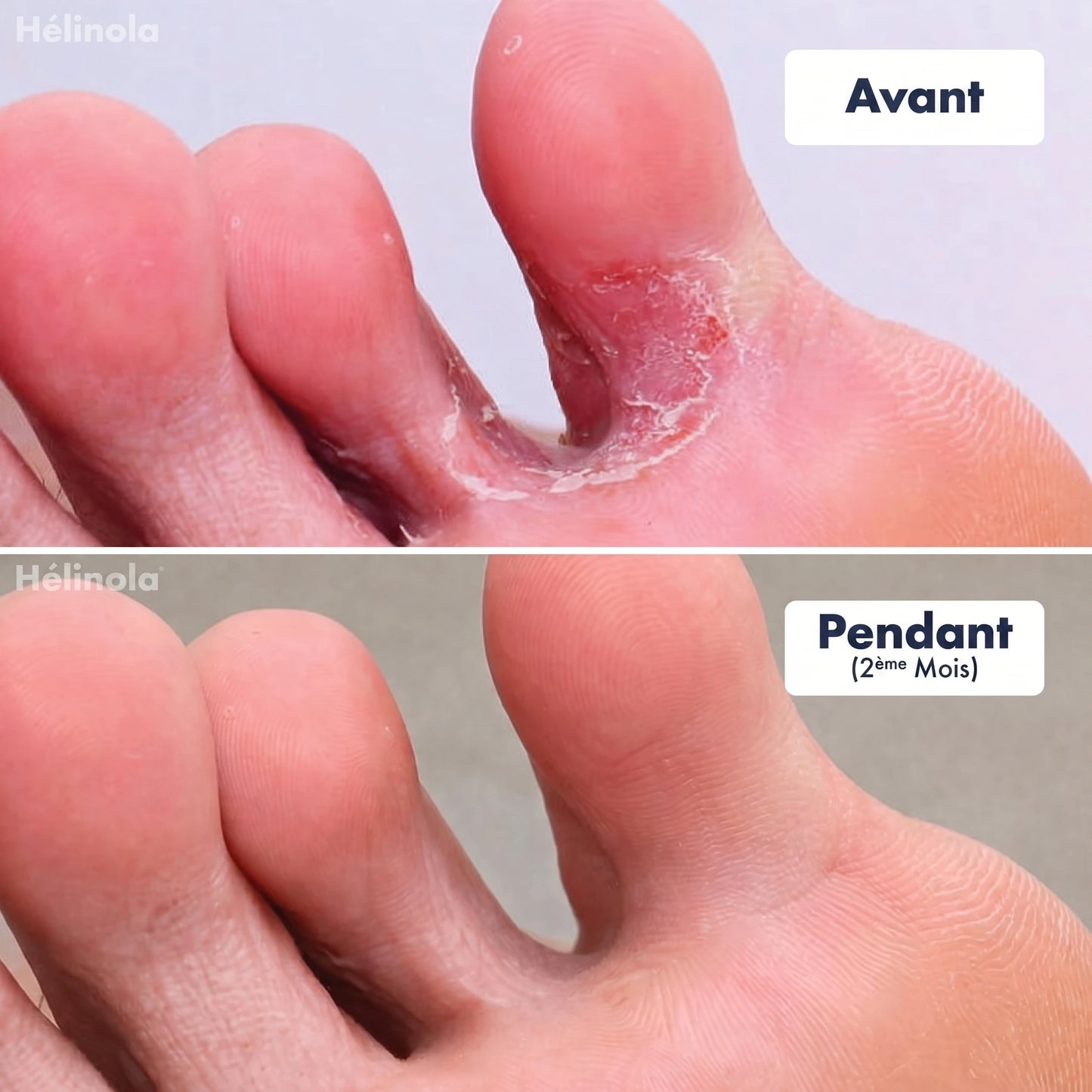 Stylo Traitement des Pieds