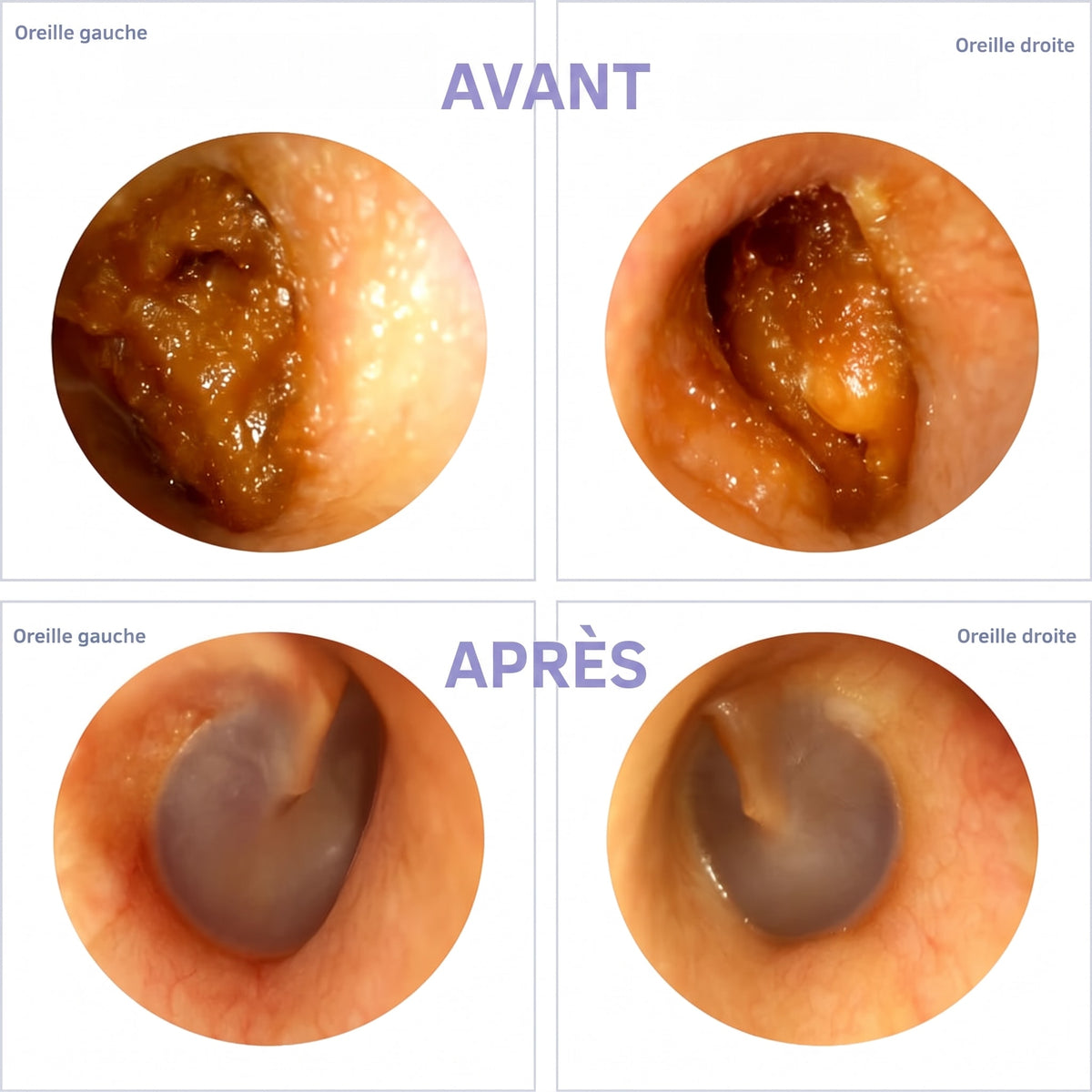 OtoClean – avant / après