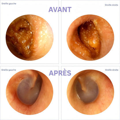 OtoClean – avant / après
